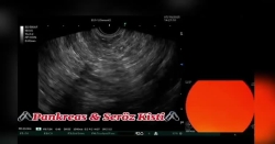 Pankreas & Seröz kisti