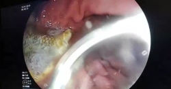 Pankreas nekrozunda uyguladığımız stentin işlevi bitince mideden dışarı çıkardık.Nekroz tamamen kurudu ve hastamız eski sağlığına kavuştu..