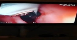 Yemek borusuna yerleştirdiğimiz kapsül HP metre ile hastamızın reflüsünü tespit etmek daha da kolaylaştı.