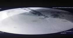Özefagus varis kanaması olan hastamıza Coil (sentetik damar tıkayıcı) uygulandıktan sonra skopi eşliğinde coil yerleştirilmiş hali.