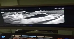 Coil uygulanmadan önce mide varisinin doppler görünümü.Varisler üzüm salkımı tarzında görüntü vermektedir.