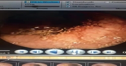 Uzun yıllardan beri karın ağrısı olan hastamıza KAPSÜL ENDOSKOPİ uygulayarak Crohn hastalığını yakaladık ve tedaviye başladık..