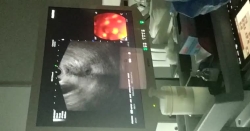 Pankreas kanserinin ayırıcı tanısında endoskopik ultrasonografinin önemi