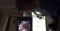 Endoskopik Ultrasonografi(EUS) ile insülinoma tanısı alan vakamız